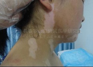 女性颈部白癜风6个月